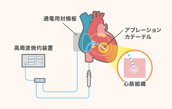 カテーテルアブレーション