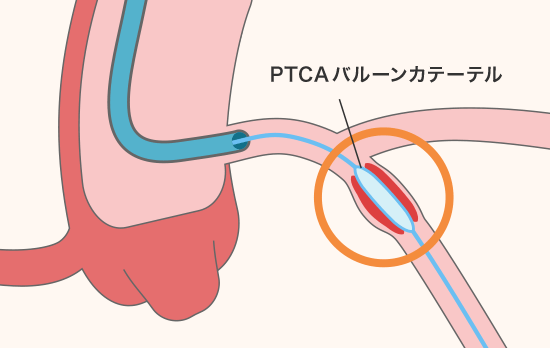 非薬物療法（機械を使った治療や外科治療）について | 心不全の
